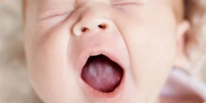 Язвочки на языке у ребенка: 6 признаков и причин, симптомы, 7 методов лечения