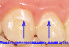 Как бороться с повышенной чувствительностью зубов: причины повышенной чувствительности зубов и методы их устранения