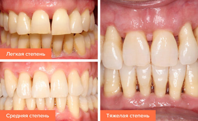 Как бороться с повышенной чувствительностью зубов: причины повышенной чувствительности зубов и методы их устранения