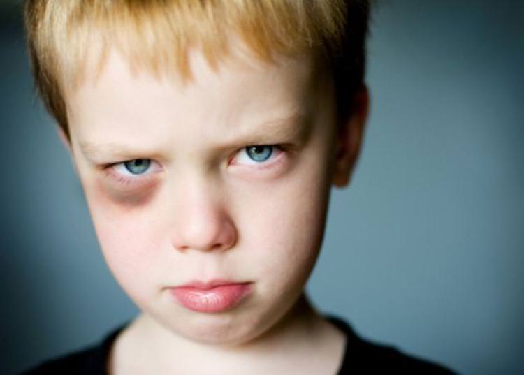 Как быстро убрать синяк под глазом — лечение кровоподтека