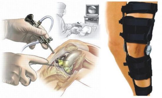Как долго  заживает сустав: последствия артроскопии и прогноз после операции 