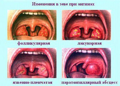 Как и чем лечить ангину в домашних условиях &mdash; народные способы
