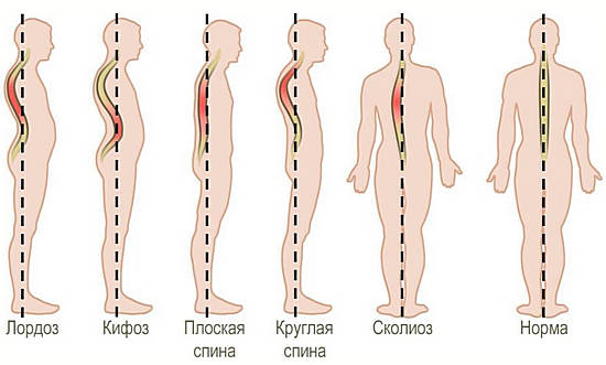 Как исправить, выпрямить осанку &mdash; советы сутулым