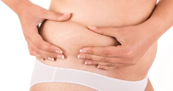 Как избавиться от растяжек? салонные и домашние способы