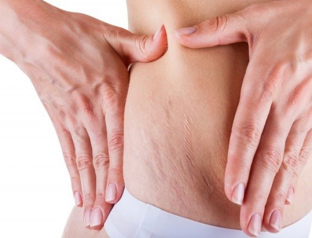 Как избавиться от растяжек? салонные и домашние способы