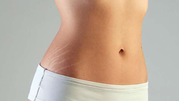 Как избавиться от растяжек? салонные и домашние способы