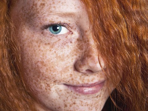 Как избавиться от веснушек на лице, теле, ошибки при их выведении