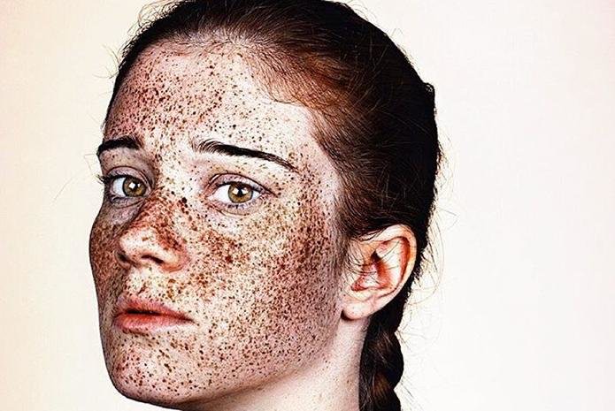 Как избавиться от веснушек на лице, теле, ошибки при их выведении