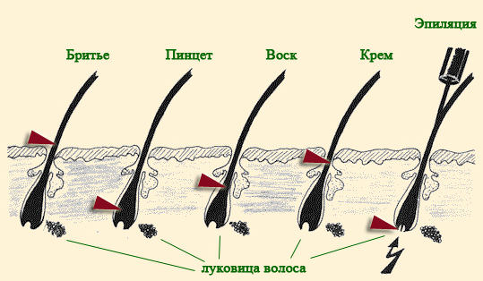 Как избавиться от волос на теле навсегда в домашних условиях