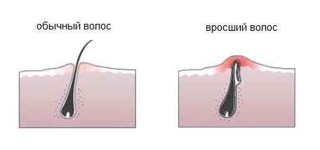 Как избавиться от вросших волос, почему врастают волосы, средства от вросших волос