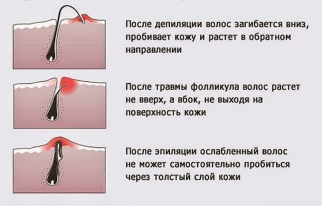 Как избавиться от вросших волос, почему врастают волосы, средства от вросших волос