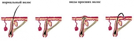 Как избавиться от вросших волос, почему врастают волосы, средства от вросших волос