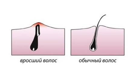 Как избавиться от вросших волос, почему врастают волосы, средства от вросших волос