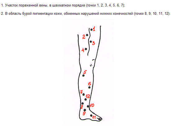 Точки куда ставить пиявки в домашних условиях в картинках