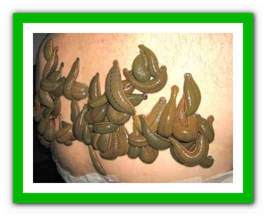 Как я ставила пиявки? лечение пиявками в домашних условиях