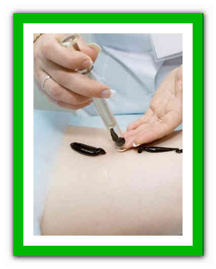 Как я ставила пиявки? лечение пиявками в домашних условиях