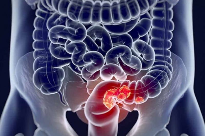 Как лечат рак кишечника &mdash; новейшие методы лечения