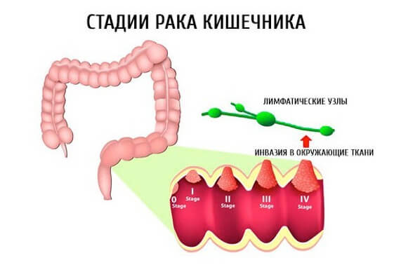 Как лечат рак кишечника &mdash; новейшие методы лечения