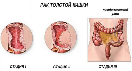 Как лечат рак кишечника &mdash; новейшие методы лечения