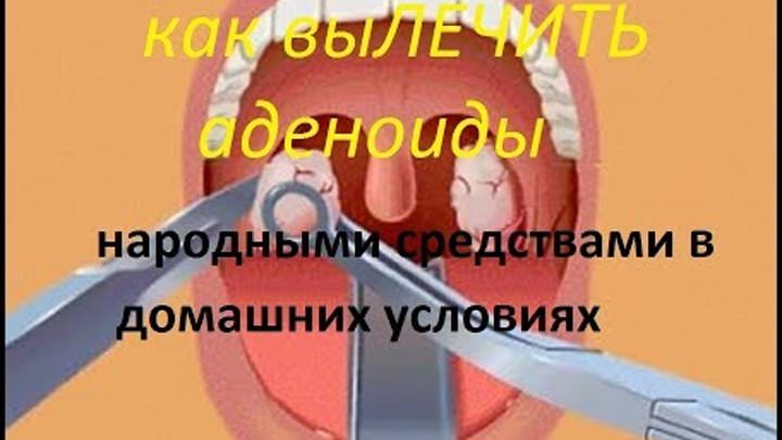 Как лечить аденоиды дома — аденоиды и народная медицина