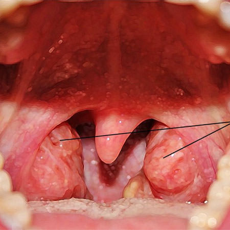 Как лечить аденоиды дома — аденоиды и народная медицина