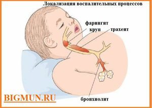 Как лечить кашель ребенка при трахеите?