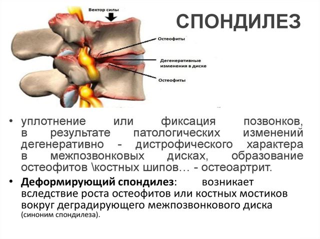 Как лечить седалищный нерв в домашних условиях, к какому врачу обращаться