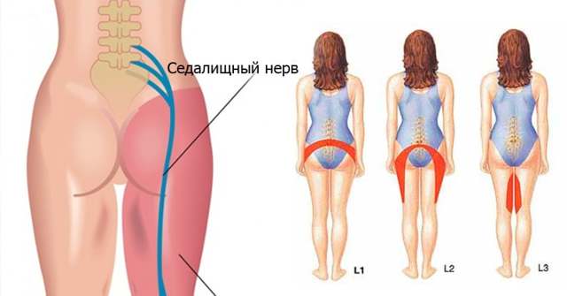 Как лечить седалищный нерв в домашних условиях, к какому врачу обращаться