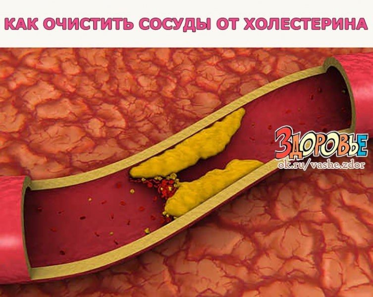 Как очистить сосуды от холестерина