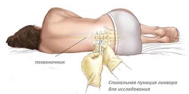 Как определить менингит у ребенка, диагностирование в домашних условиях