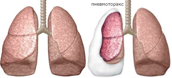 Как определить перелом ребра по рентгеновскому снимку: расшифровка рентгена