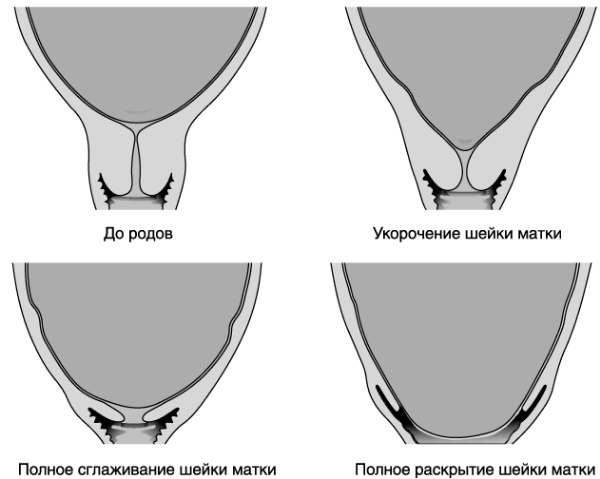 Как отходят воды перед родами, что означают зеленые воды при родах