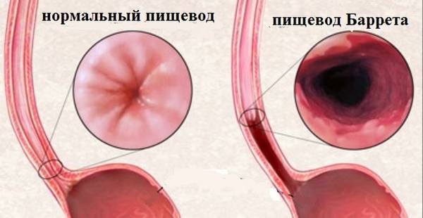 Как отличить невроз от других заболеваний: правила дифференцирования невроза от грыжи пищеводного отверстия диафрагмы