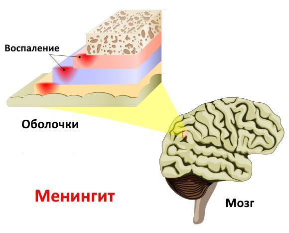 Как передается менингит вирусный, как можно заразиться от человека