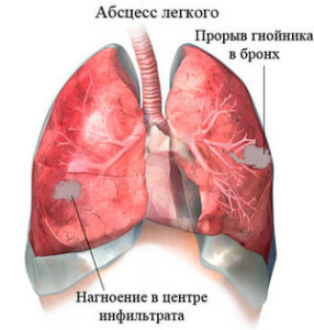 Как подтвердить золотистый стафилококк на коже?