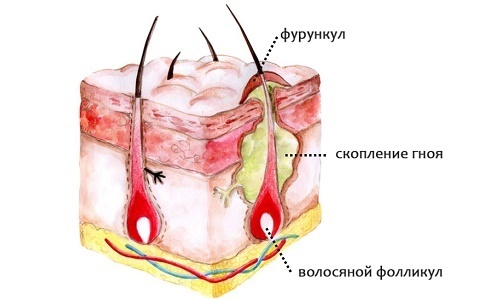 Как подтвердить золотистый стафилококк на коже?