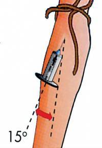 Как правильно делать забор крови из вены: правила инъекции