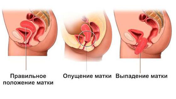 Как происходит лечение опущения матки