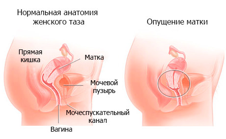 Как происходит лечение опущения матки