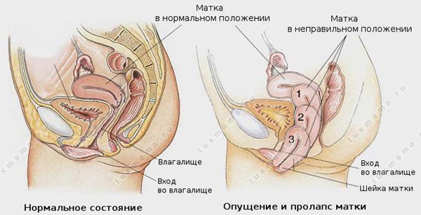 Как происходит лечение опущения матки