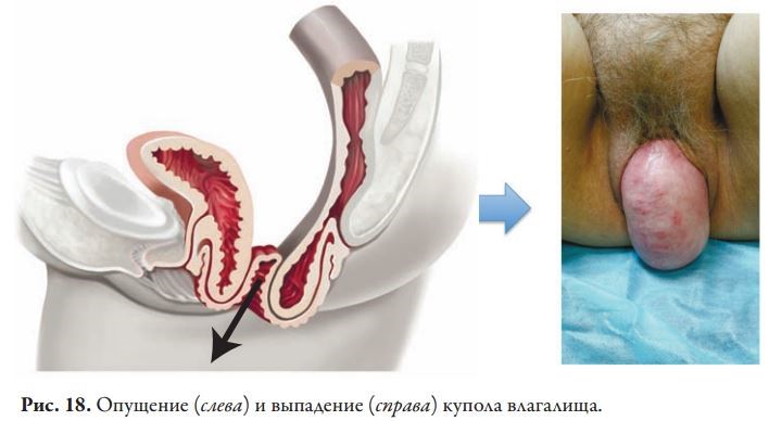 Как происходит лечение опущения матки