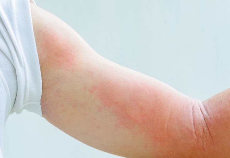 Как проявляется аллергия или основные симптомы аллергии