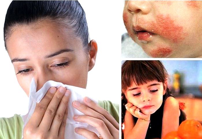 Как проявляется аллергия или основные симптомы аллергии