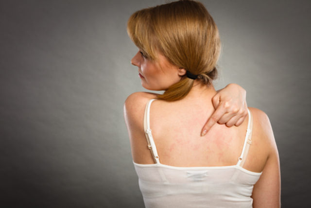 Как проявляется аллергия или основные симптомы аллергии