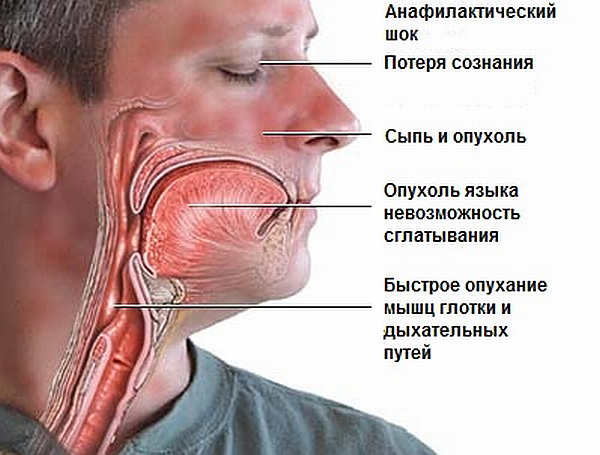 Как проявляется аллергия на алкоголь и отчего появляются красные пятна на лице