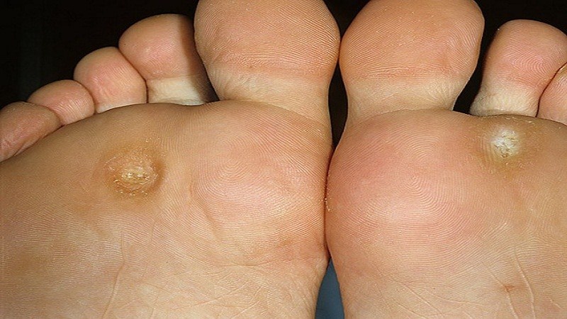 Как просто избавиться от натоптышей в домашних условиях