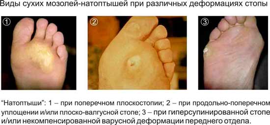 Как просто избавиться от натоптышей в домашних условиях