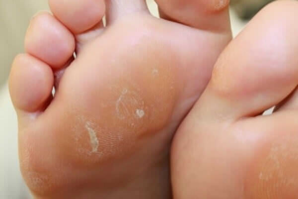 Как просто избавиться от натоптышей в домашних условиях