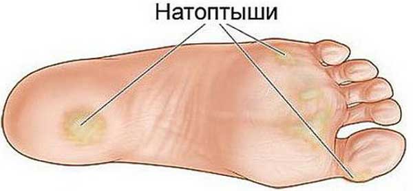 Как просто избавиться от натоптышей в домашних условиях