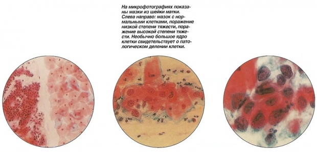 Как расшифровать цитологический анализ